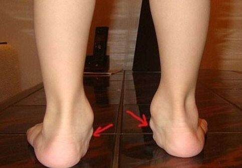 Valgus deformarea picioarelor la copii