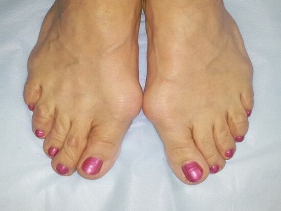 Hallux valgus deformarea picioarelor